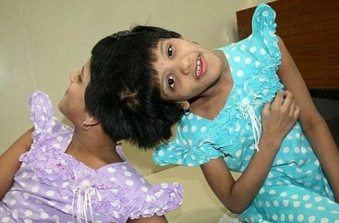 After years of suspense, now doctors say separating Hyderabad conjoined twins too risky