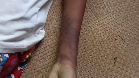 Jellyfish sting claims life of 10-year-old girl in Palawan