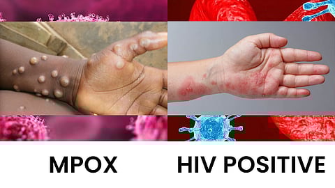 Monkeypox, HIV not connected