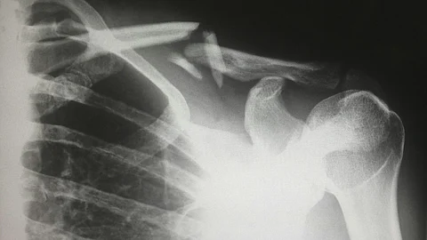 Filipino researchers develop affordable bone fracture treatment