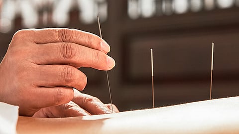 Acupuncture, a traditional Chinese medicine which entails piercing of hair-thin needles in certain points of the body to improve the flow of blocked or stagnant qi, is now included among the treatment services available in tertiary government hospitals.