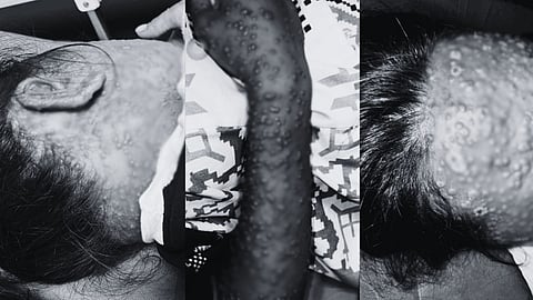 Health authorities issue monkeypox alert in Lanao del Sur.
