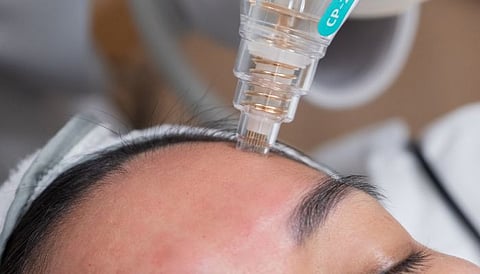 Potenza RF Microneedling + AnteAGE MDX Exosomes treatment.