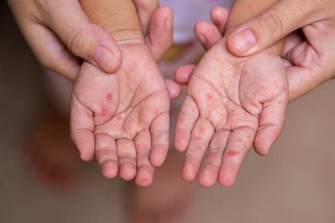 Hand, foot, and mouth disease cases surge