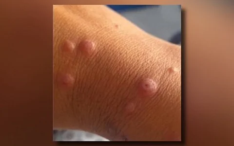 Mpox cases recorded in CV, other areas