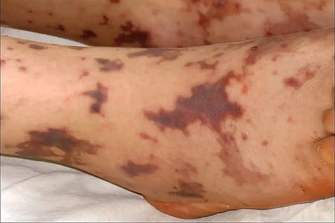 Meningococcal disease
