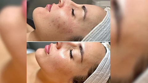 The treatment starts with a lympathic massage to help the patient relax.