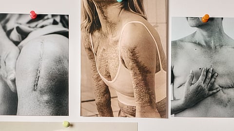 The Scar Project honors scars as stories of strength, healing and resilience.