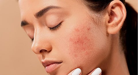 Scientists discover 29 new acne risk genes