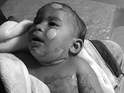 Angered neighbourer girl threw boiling lentils on mother and her 10-month-old daughter