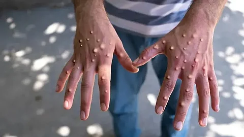 Mpox, Mpox India, Mpox WHO, Mpox WHO Global Health Emergency, What is Mpox, Mpox Precautions, Mpox Treatment, Mpox Pakistan, Mpox Origin, How Mpox Spread