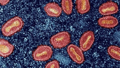 Expert urges health officials to begin screening for Mpox at airports in India