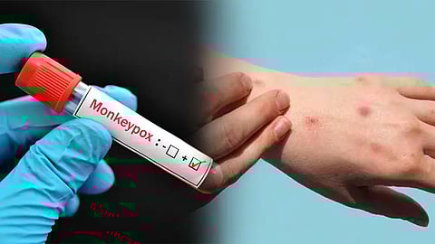 Mpox in India, Monkeypox in India, Monkeypox Indian Patient