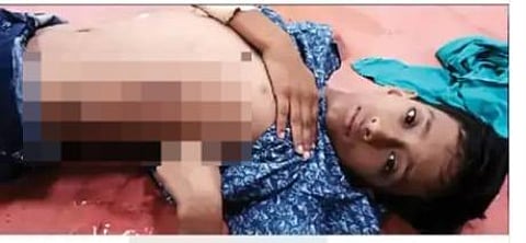 Mohali: Child gets electric shock; Deep wounds in the stomach, Family alleges- PSPCL is asking for money to set the wires