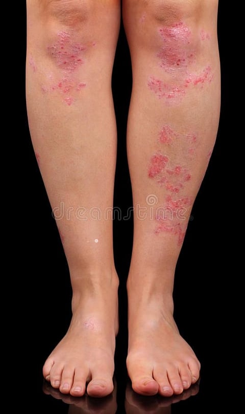 Tips to avoid fungal infection during the rainy season