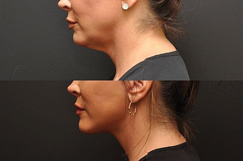 It’s the Most Wonderful Time of the Year… for Facial Rejuvenation