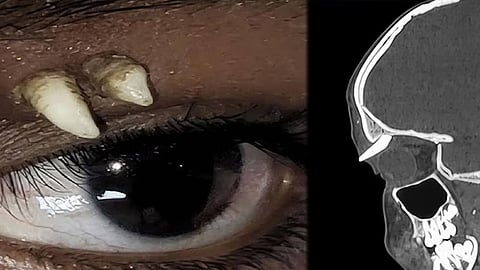 Indian boy tooth in eye