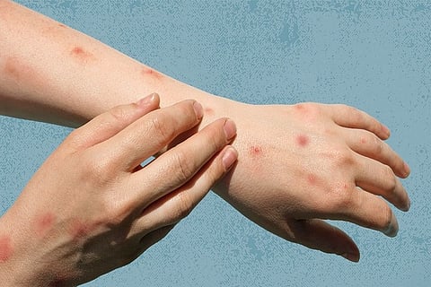 Monkey Pox: ದೇಶದಲ್ಲಿ ಹೆಚ್ಚಿದ ಮಂಗನ ಕಾಯಿಲೆ..ಕೇರಳದಲ್ಲಿ ಎರಡನೇ ಪ್ರಕರಣ ಪತ್ತೆ