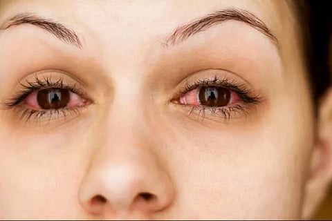 pinkeye