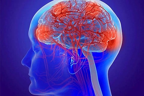 Brain Stroke