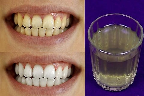 Teeth Cleaning