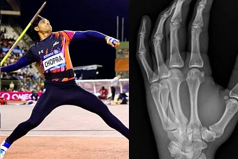 Neeraj Chopra, X ray