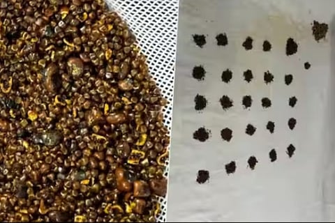 Over 6000 stones surgically removed from 70 year-old mans gallbladder in Kota