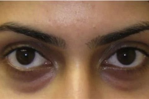 Dark circle under eye