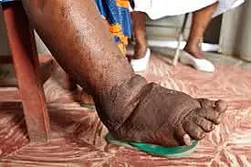 filariasis