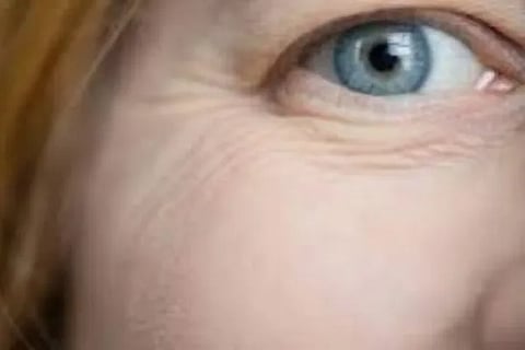 eye wrinkles
