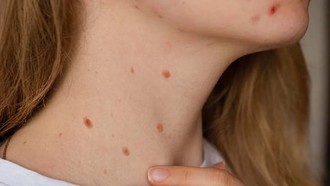 Chickenpox