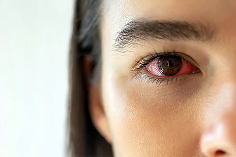 Red Eye