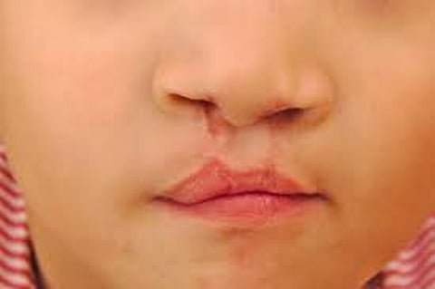 Clift lip