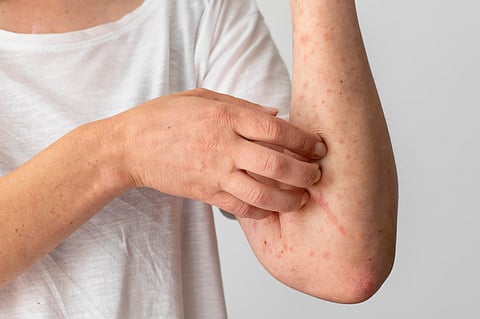 Canada Loses Measles-Free Status After Major Outbreak