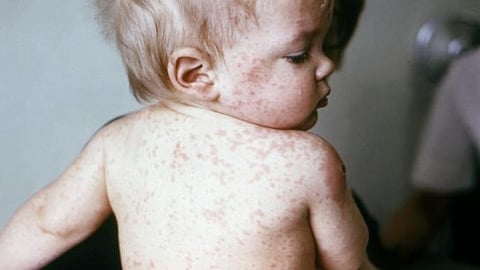 Measles
