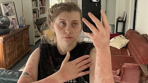 Isabella Krohn and her eczema