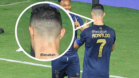 رونالدو بالحجامة