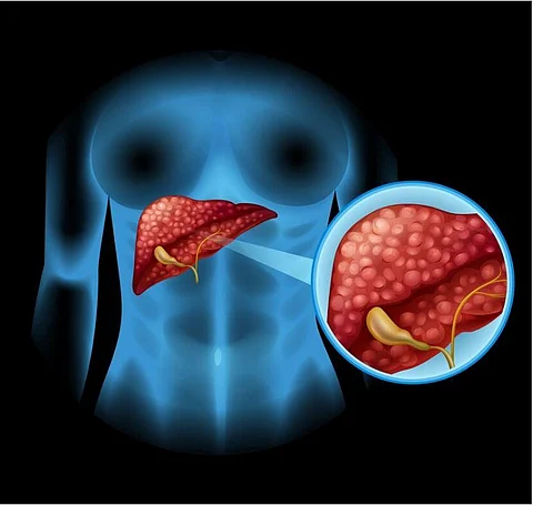 Pancreatic cancer is the twelfth most common cancer globally, but it accounts for five per cent of cancer-related deaths due to its high fatality rate.