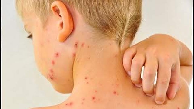 6 744 Chickenpox Cases 9 Deaths In 75 Days In Kerala 6 744 Chickenpox Cases 9 Deaths In 75 Days In Kerala