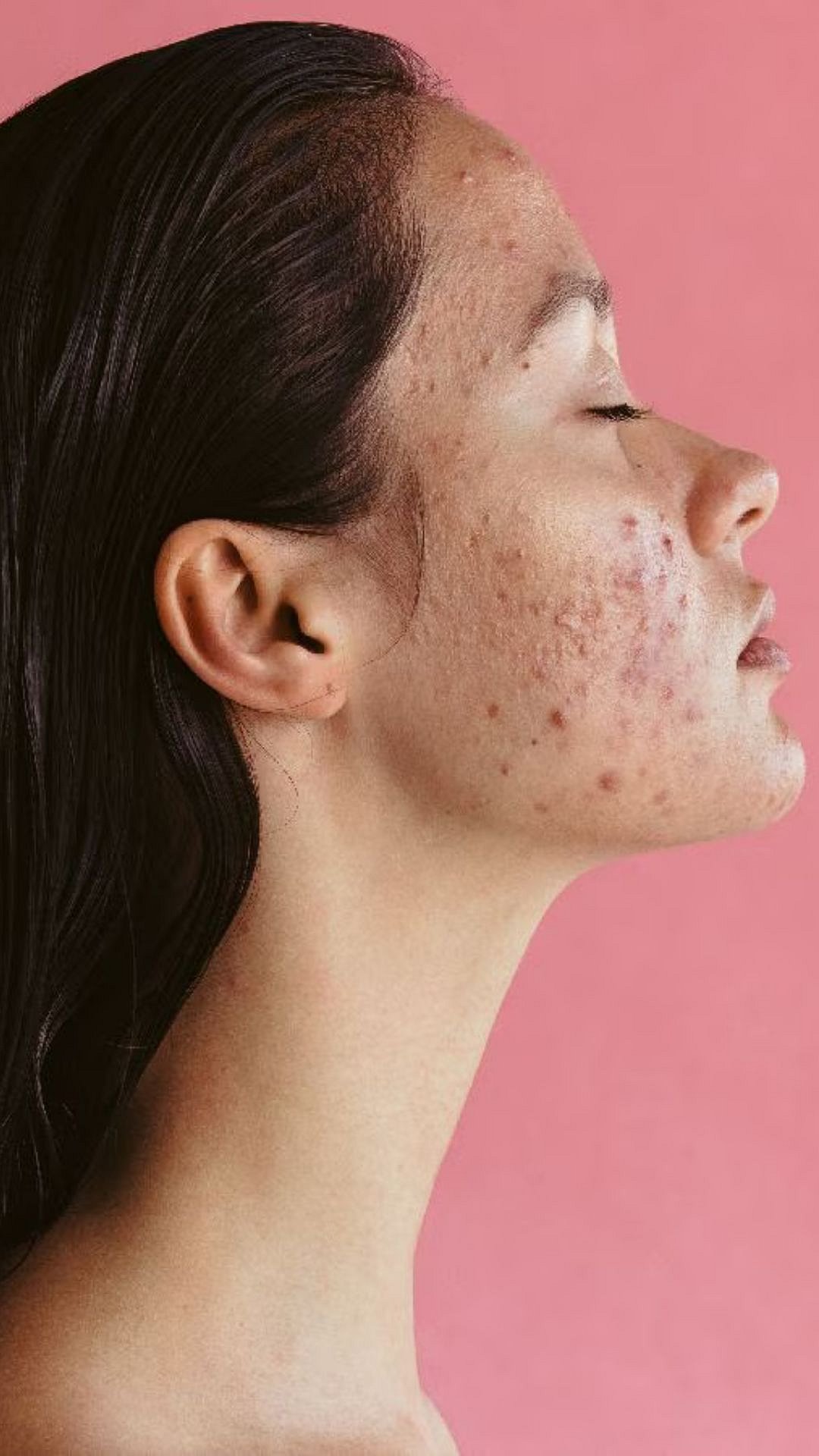 PMS Acne Causes : मासिक पाळी येण्याअगोदर चेहऱ्यावर पिंपल्स का येतात ...