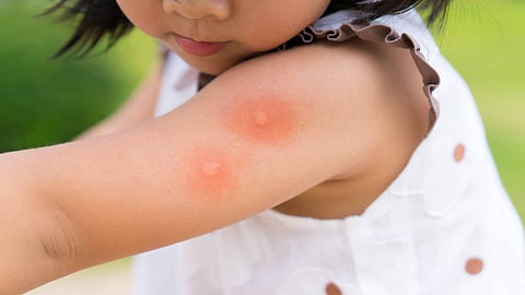 حماية الأطفال من مخاطر لدغة القراد