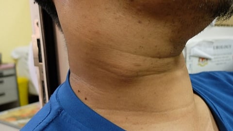 سرطان الغدد الليمفاوية
