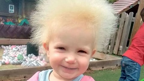  متلازمة الشعر غير القابل للتمشيط  