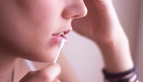 الهربس الفموي