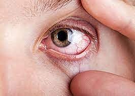 كيف تتصرف في حال دخول جسم غريب بالعين؟