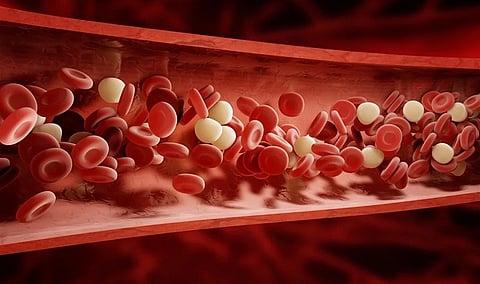 فرط شحميات الدم