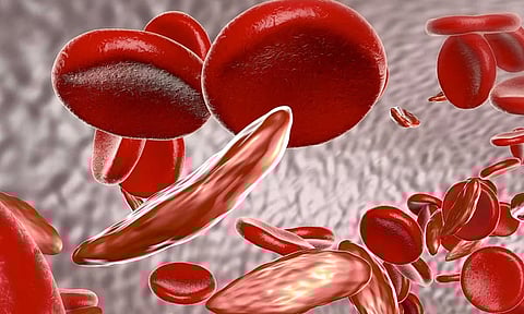 أسباب فقر الدم الناتج عن نقص الحديد في الجسم 