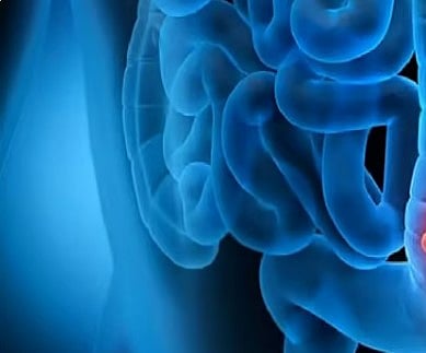 استشاري يوضح أسباب وعلاج قرحة القولون