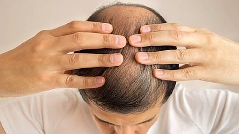 طبيبة أمراض جلدية  توضح حقيقة فاعلية الزيوت في علاج الصلع الوراثي
