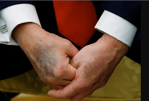 كدمات متكررة على يد «ترامب» تثير الجدل.. والبيت الأبيض يعلق